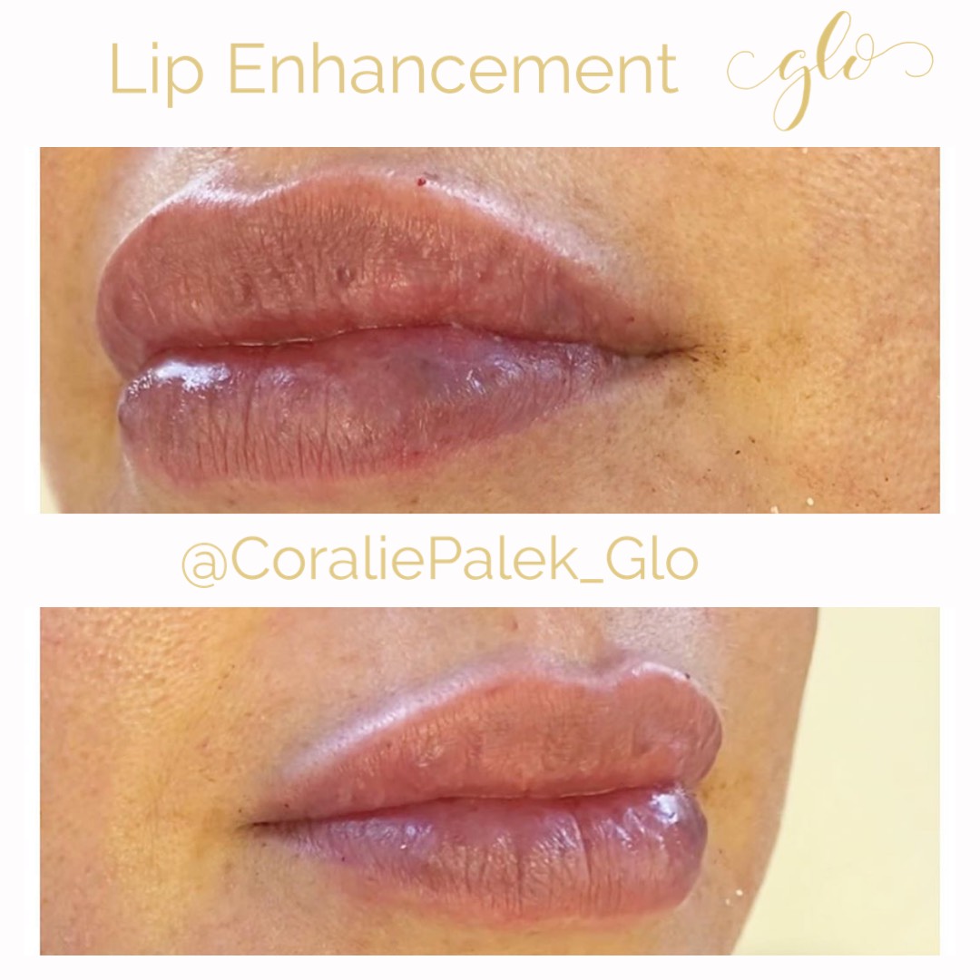 Dermal Filler at Glo Esthetics in Far Hills, NJ