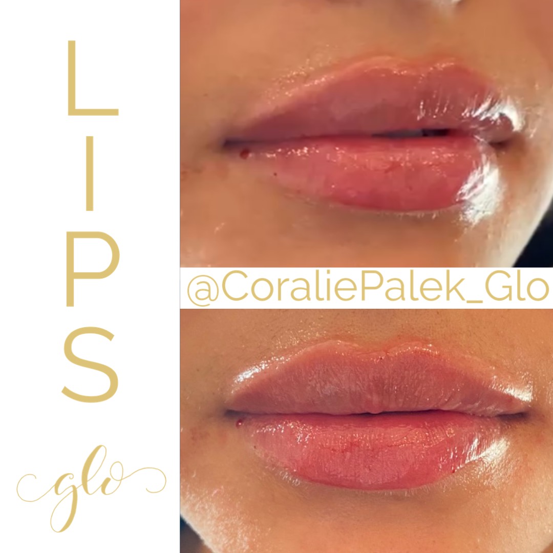 Dermal Filler Treatment by Glo Aesthetics