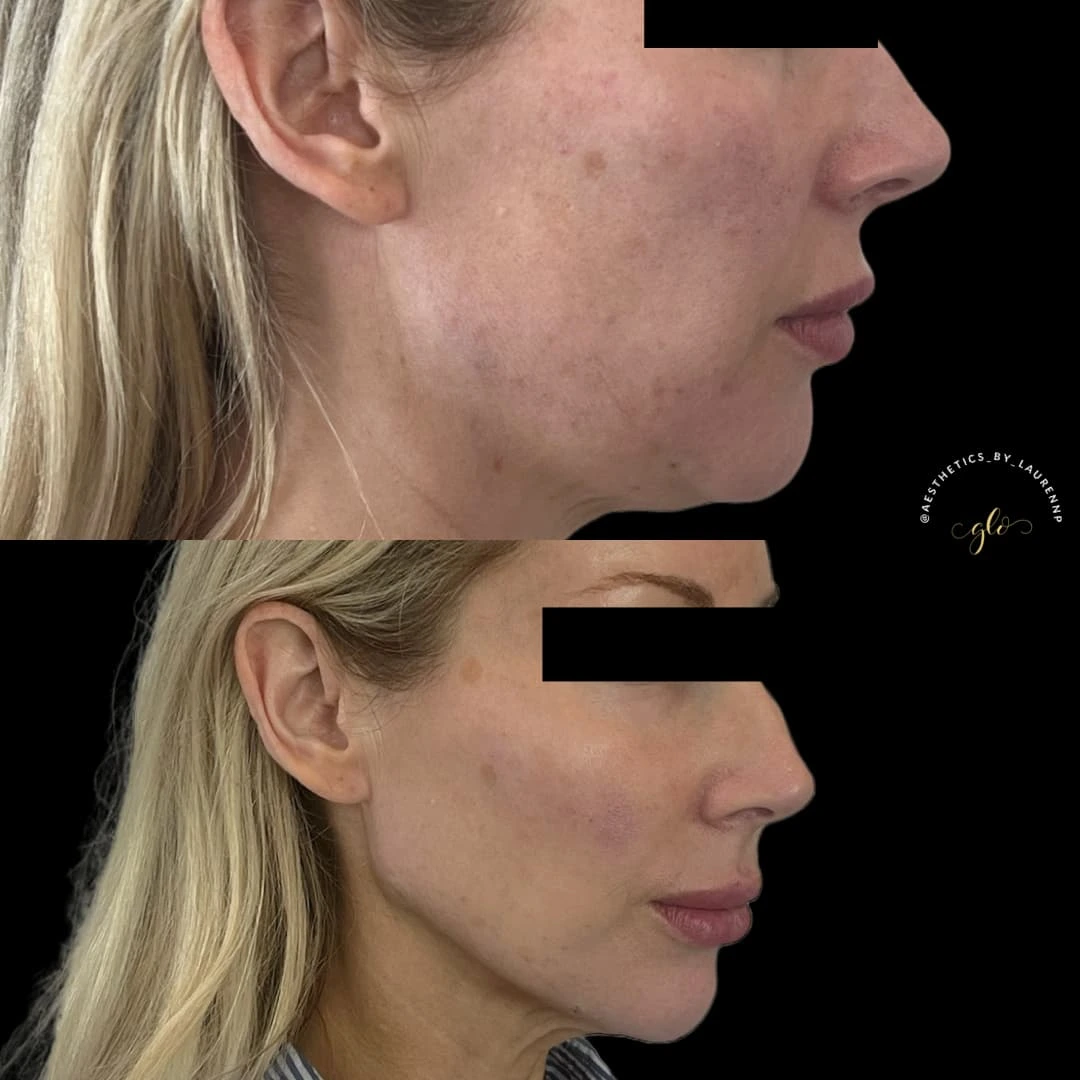 Dermal Fillers Treatment at Glo Esthetics in Far Hills, NJ