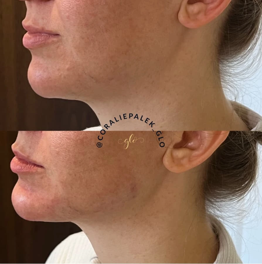 Dermal Fillers Treatment at Glo Esthetics in Far Hills, NJ