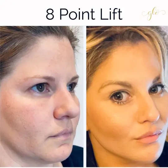 Dermal Fillers Treatment at Glo Esthetics in Far Hills, NJ