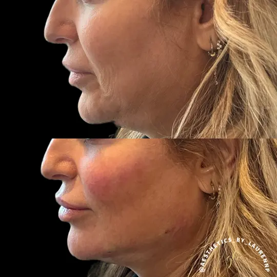 Dermal Fillers Treatment at Glo Esthetics in Far Hills, NJ