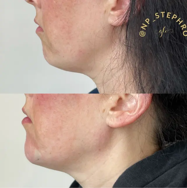 Dermal Fillers Treatment at Glo Esthetics in Far Hills, NJ