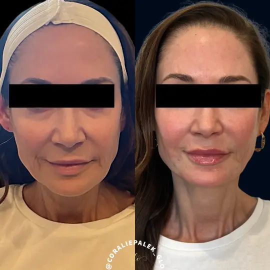 Dermal Fillers Treatment at Glo Esthetics in Far Hills, NJ