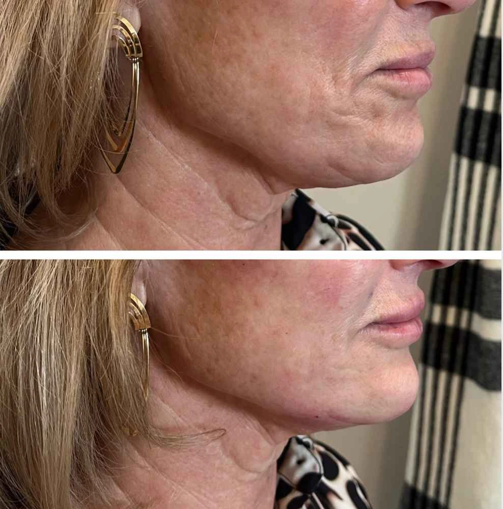 Dermal Fillers Treatment at Glo Esthetics in Far Hills, NJ