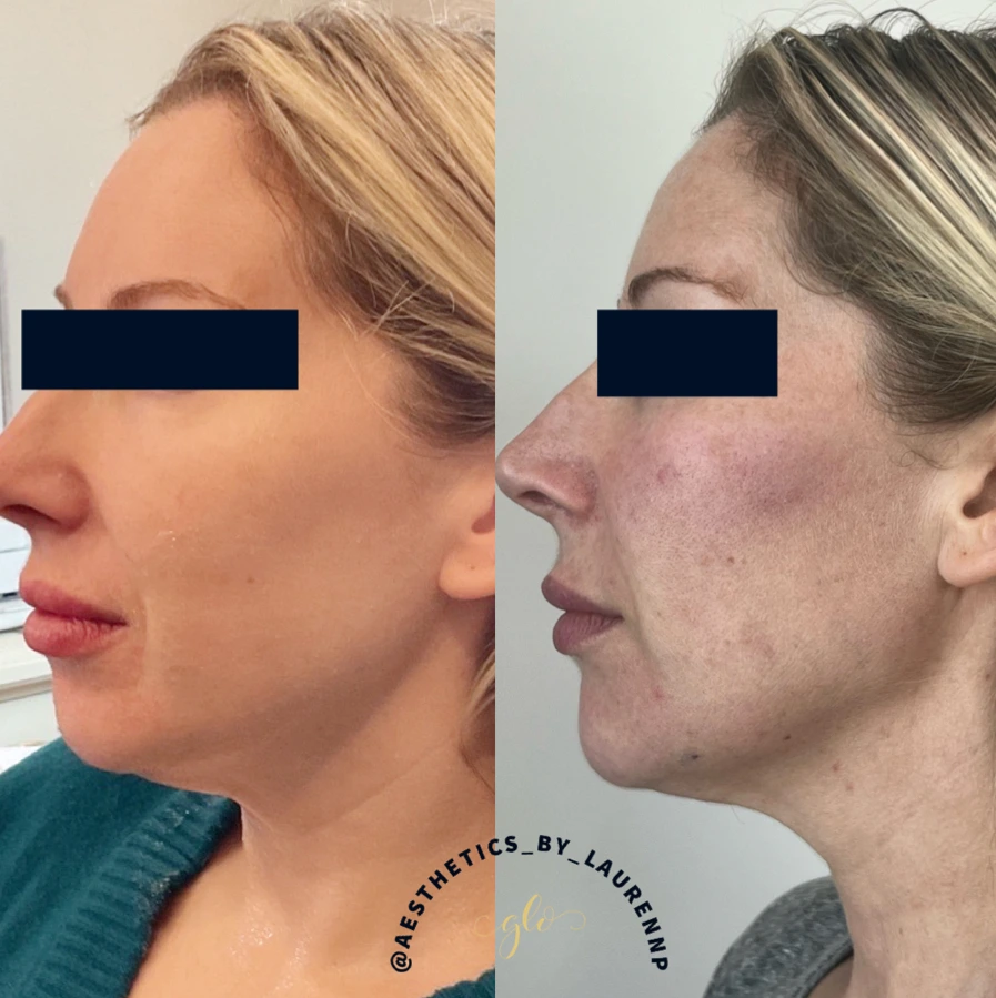 Dermal Fillers Treatment at Glo Esthetics in Far Hills, NJ